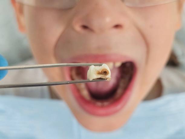 Best Emergency Dental Care for Abscessed Tooth in Five Points, NC